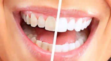 وصفة طبيعية لتبييض الأسنان وإزالة الجير في المنزل