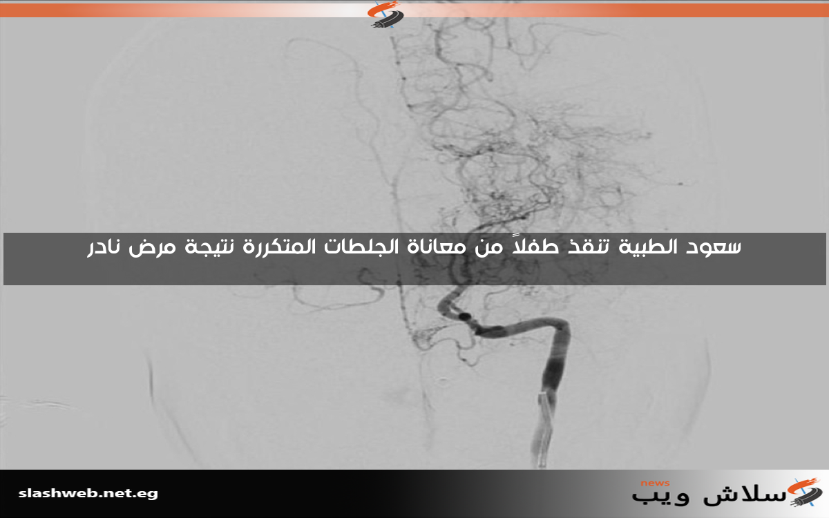 سعود الطبية تنقذ طفلاً من معاناة الجلطات المتكررة نتيجة مرض نادر