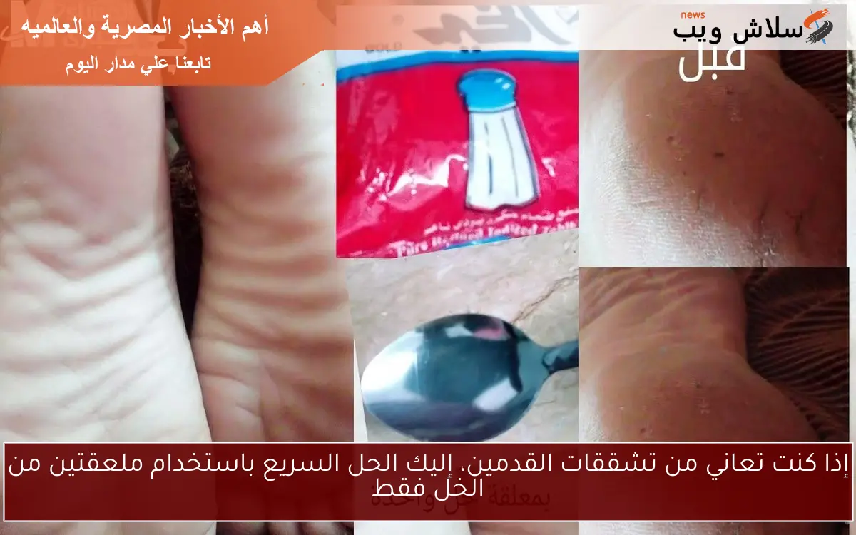 إذا كنت تعاني من تشققات القدمين، إليك الحل السريع باستخدام ملعقتين من الخل فقط