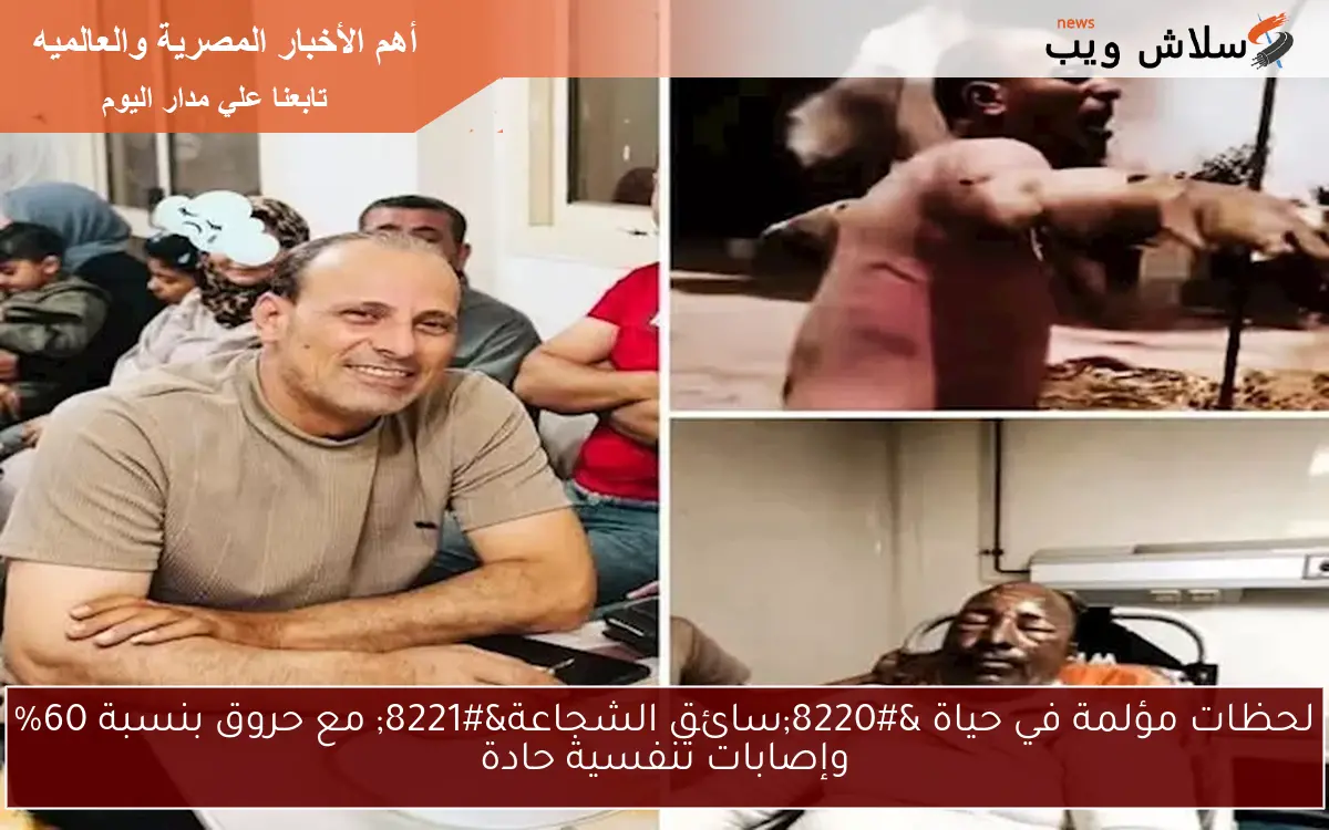 لحظات مؤلمة في حياة “سائق الشجاعة” مع حروق بنسبة 60% وإصابات تنفسية حادة
