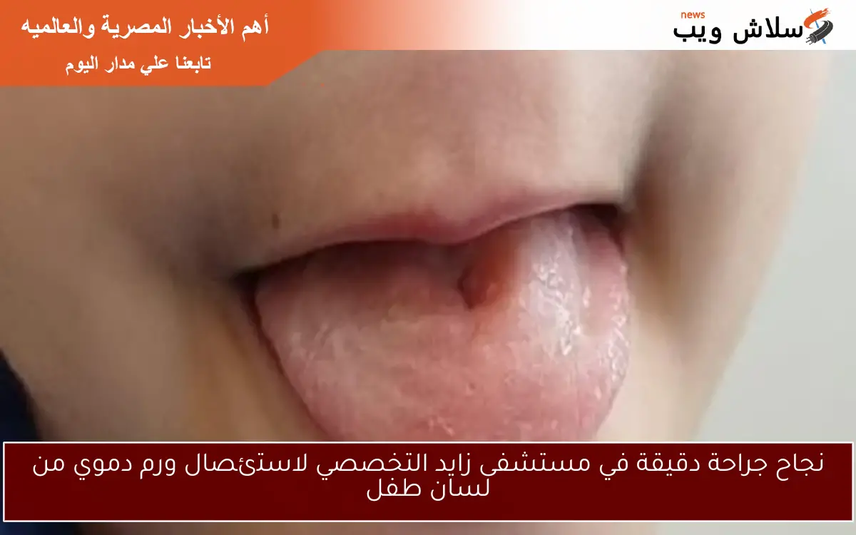 نجاح جراحة دقيقة في مستشفى زايد التخصصي لاستئصال ورم دموي من لسان طفل